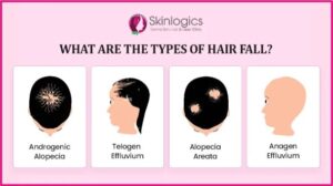 Types of Hair fall