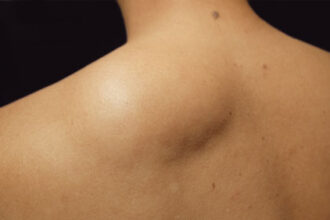 How Much Does a Single Lipoma Surgery Usually Cost?