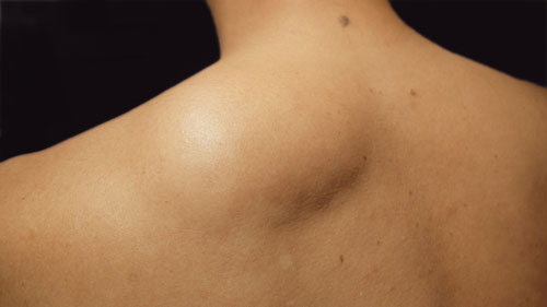 How Much Does a Single Lipoma Surgery Usually Cost?