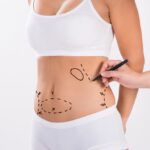 Achieve Your Dream Figure with Liposuction