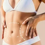 How to Make an Informed Decision Best Full Body Liposuction Surgeons in Dubai