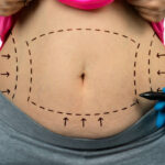 Common Myths About Tummy Tuck