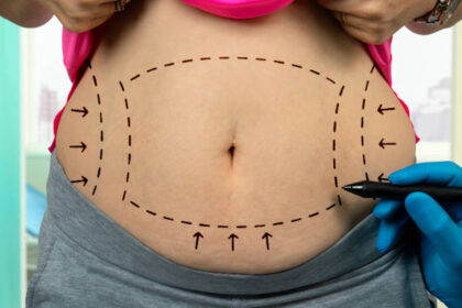 Common Myths About Tummy Tuck