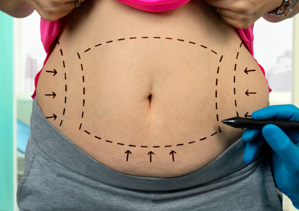 Common Myths About Tummy Tuck