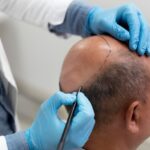 Hair Transplants: A Solution for Hair Loss in Men and Women