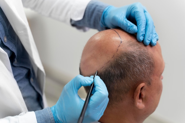 Hair Transplants: A Solution for Hair Loss in Men and Women