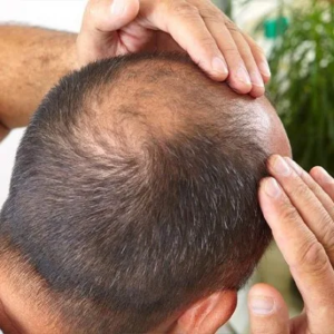 How Long Does Recovery Take After a Crown Hair Transplant?