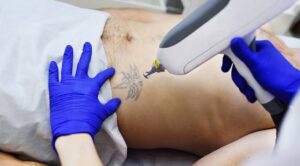 Is laser tattoo removal safe for all skin types?