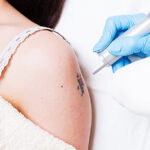 Is laser tattoo removal safe for all skin types?