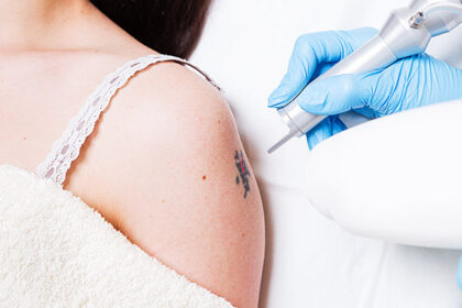 Is laser tattoo removal safe for all skin types?