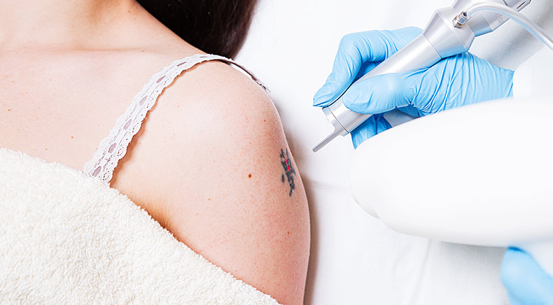 Is laser tattoo removal safe for all skin types?