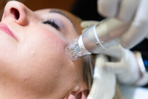 What to Expect During Laser Acne Scar Treatment