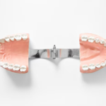 full denture implants