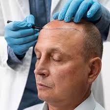 Hair Transplant in Riyadh