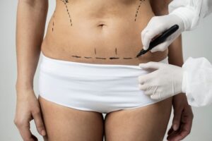 Achieving Natural Results with Mini Abdominoplasty 