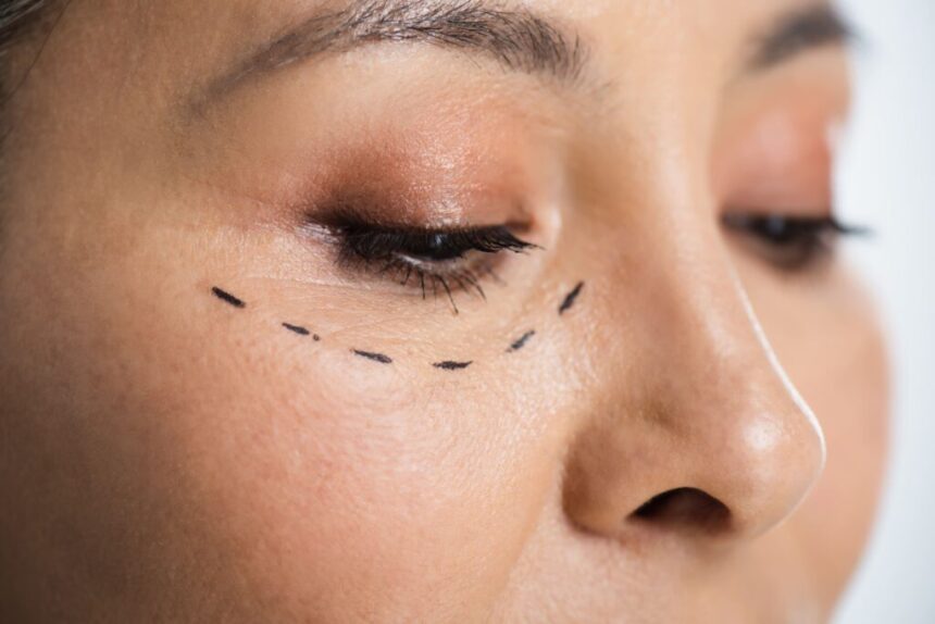 Correct Eye Bags and Sagging with Eyelid Surgery