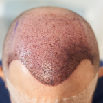 Hair transplant in Dubai