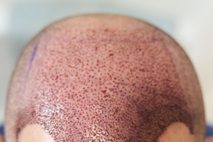 Hair transplant in Dubai