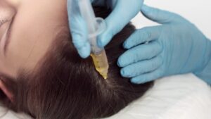 How to Prepare for PRP Hair Treatment