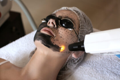 Laser Carbon Peel for Glowing Skin