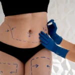 Stomach Liposuction in Dubai: Key Factors in Choosing Your Surgeon