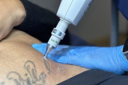 Long-Lasting Results with Laser Tattoo Removal