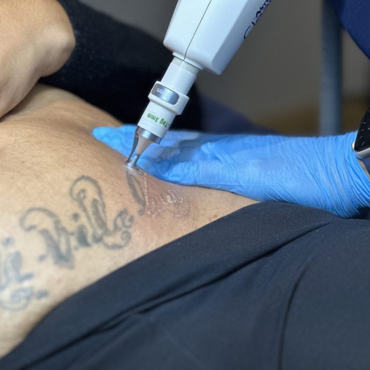 Long-Lasting Results with Laser Tattoo Removal