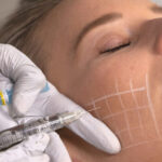 Restore Your Skin’s Vitality with Volite Fillers