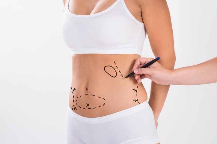 Tailored Liposculpture Plans