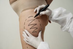 The Rise of Body Fillers A Focus on Butt Fillers