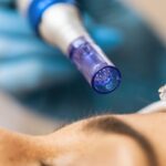 The Science Behind Microneedling for Acne Scar Removal