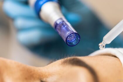 The Science Behind Microneedling for Acne Scar Removal