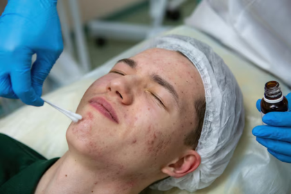 acne treatment leeds