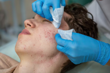 acne treatment manchester