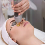 Advanced Laser Treatments for Acne Scars