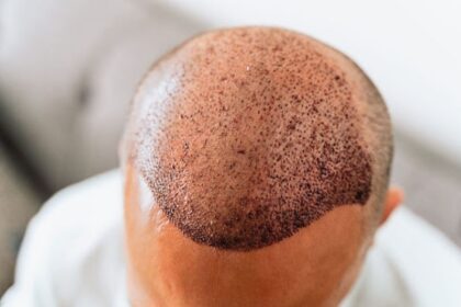 Crown Hair Transplant FAQs for Residents