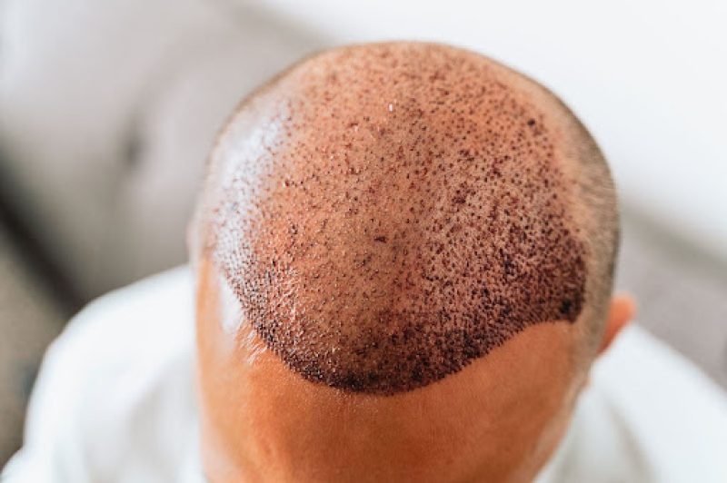 Crown Hair Transplant FAQs for Residents