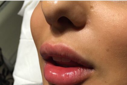 Lip filler injections in Dubai 