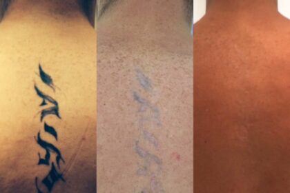 laser tattoo removal london