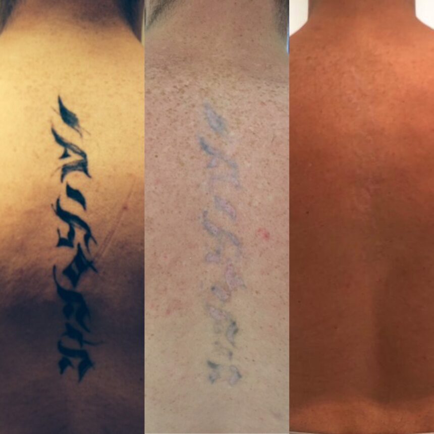 laser tattoo removal london