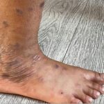 Lichen Planus Home Treatments