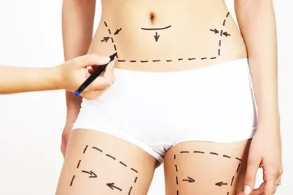 Liposuction Surgery in Dubai