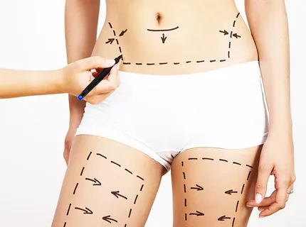 Liposuction Surgery in Dubai