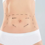 Mini Tummy Tuck Before and After Results