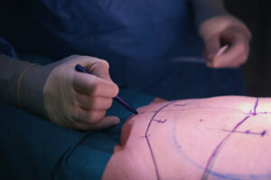 Mini tummy tuck for diastasis recti repair in Abu Dhabi