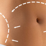 Redefine Your Waistline with Lipo Abdominoplasty