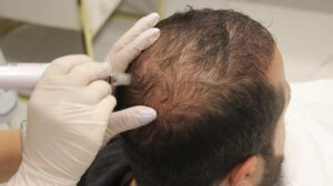 The Science Behind Hybrid Hair Transplants 