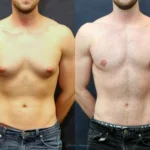 Gynecomastia surgery in Dubai