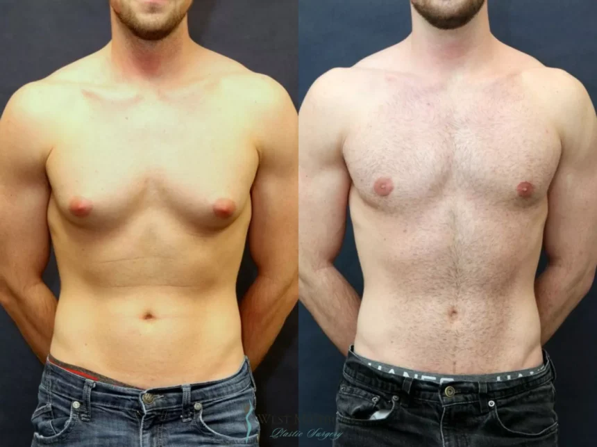 Gynecomastia surgery in Dubai