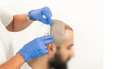 Hair Transplant in Dubai